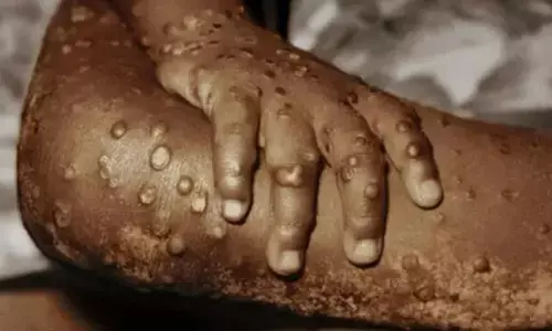 Rivers Govt. confirms 2 cases of monkeypox