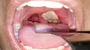 Diphteria outbreak: Imo lawmaker calls for more vigilance