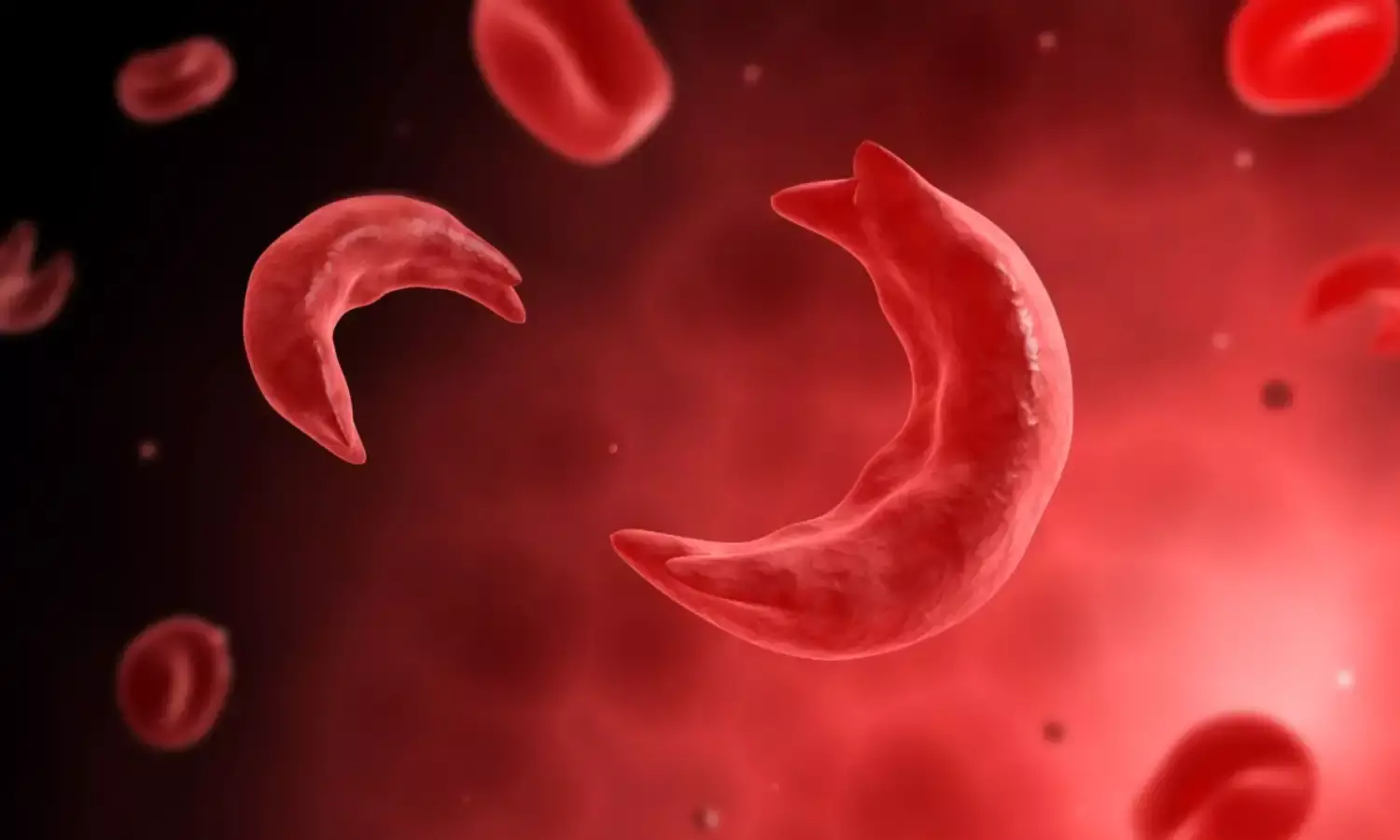 Sickle cell: Expert urge govts to invest in local manufacturing of gene therapy