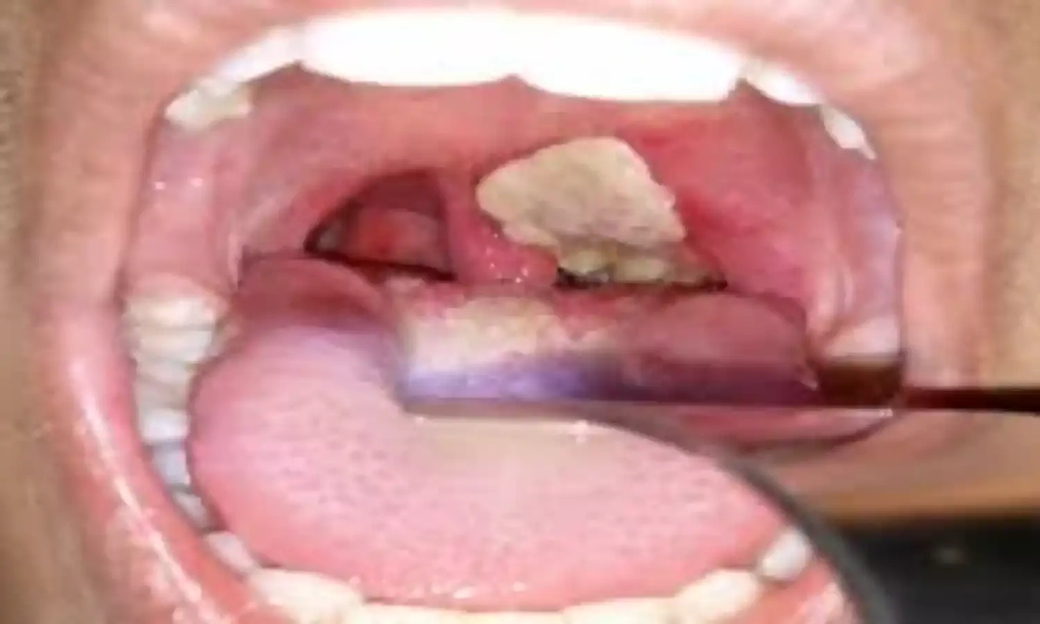 Diphtheria: UNICEF urges airport health checks to curb spread