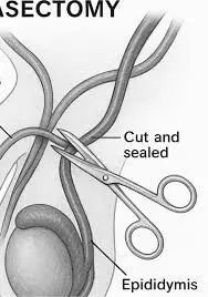 Embrace vasectomy, other safe family planning methods, experts urge Nigerian men