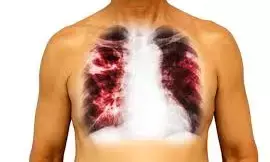 IHVN urges early detection, funding to fight MDR-TB