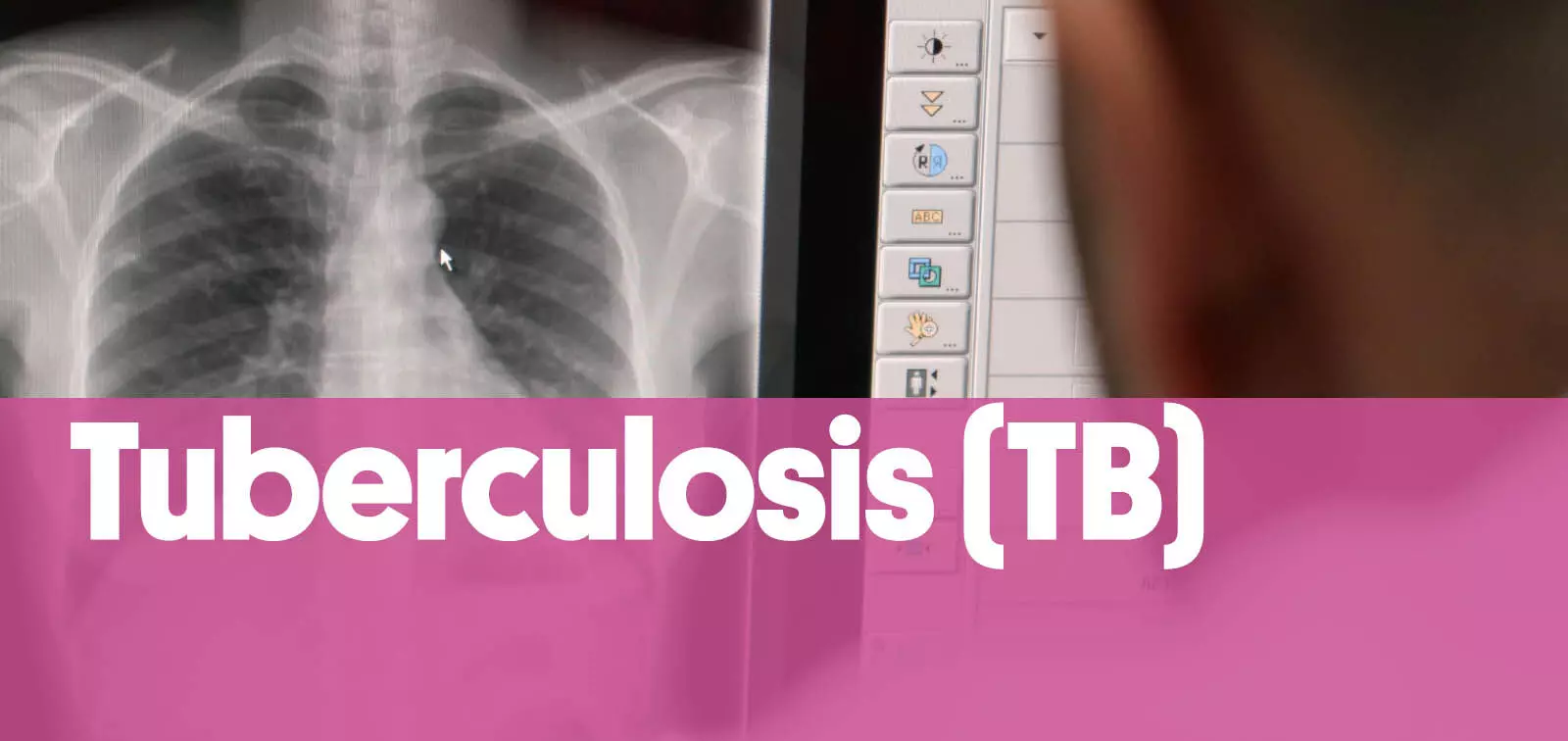 European health agencies: Tuberculosis remains a health concern