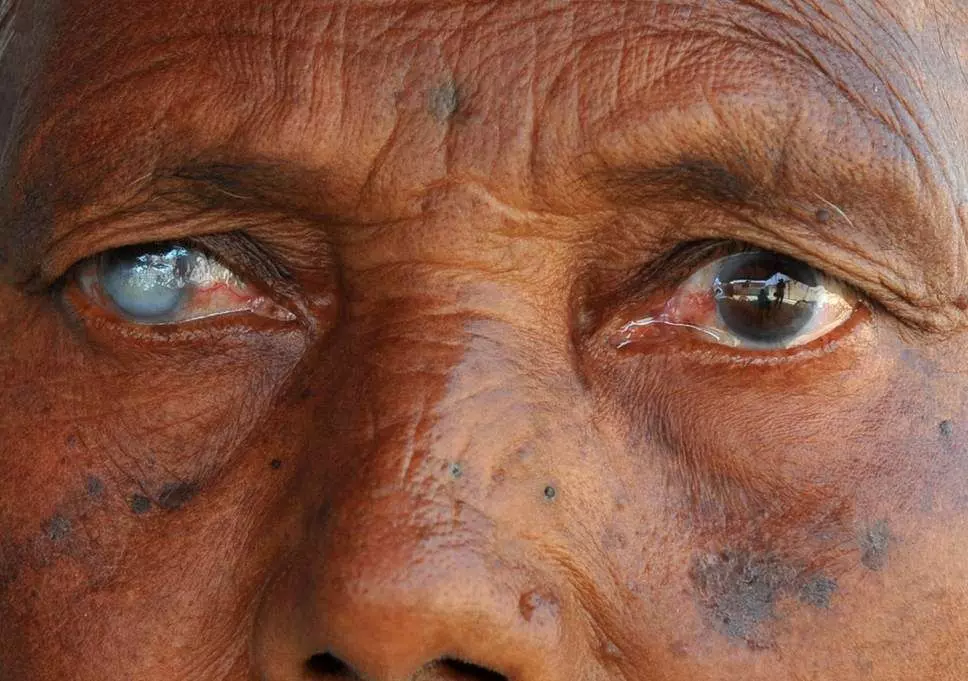 Nigerian university don develops blindness detection kits Nigerian university don develops blindness detection kits