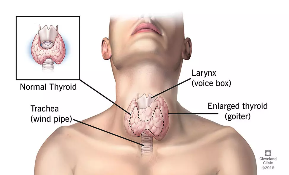 NGO calls for awareness on prevention, treatment, management of thyroid disease