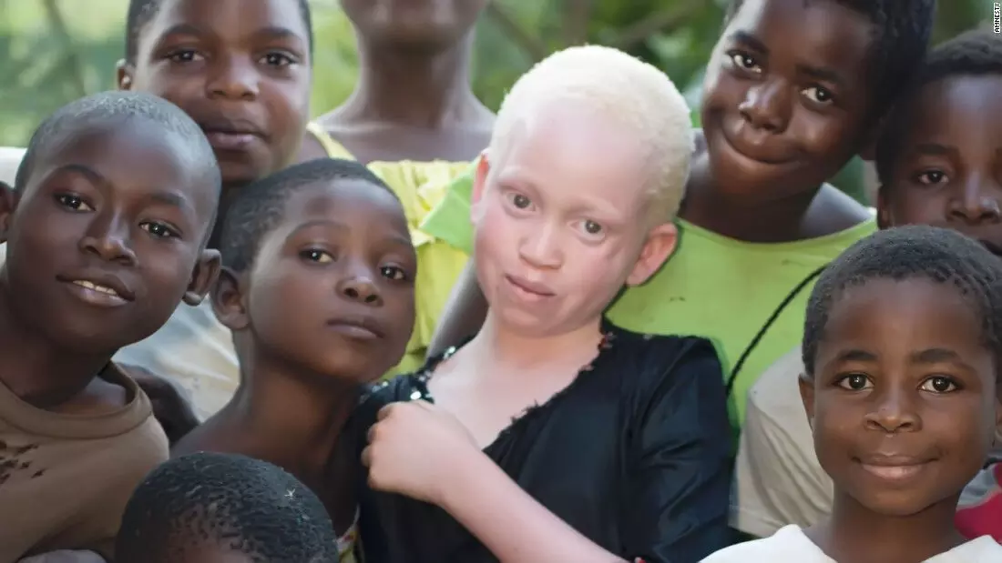 Skin cancer: Be `sun smart’, Foundation advises albinos Skin cancer: Be `sun smart’, Foundation advises albinos