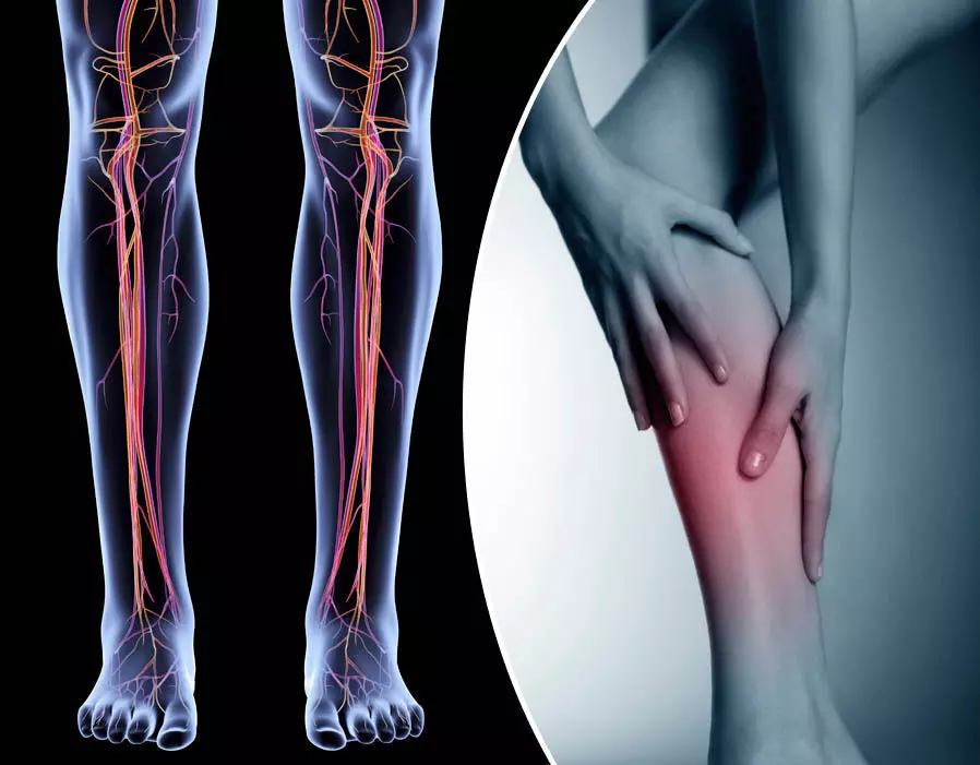 Medical expert urges early treatment of deep vein thrombosis