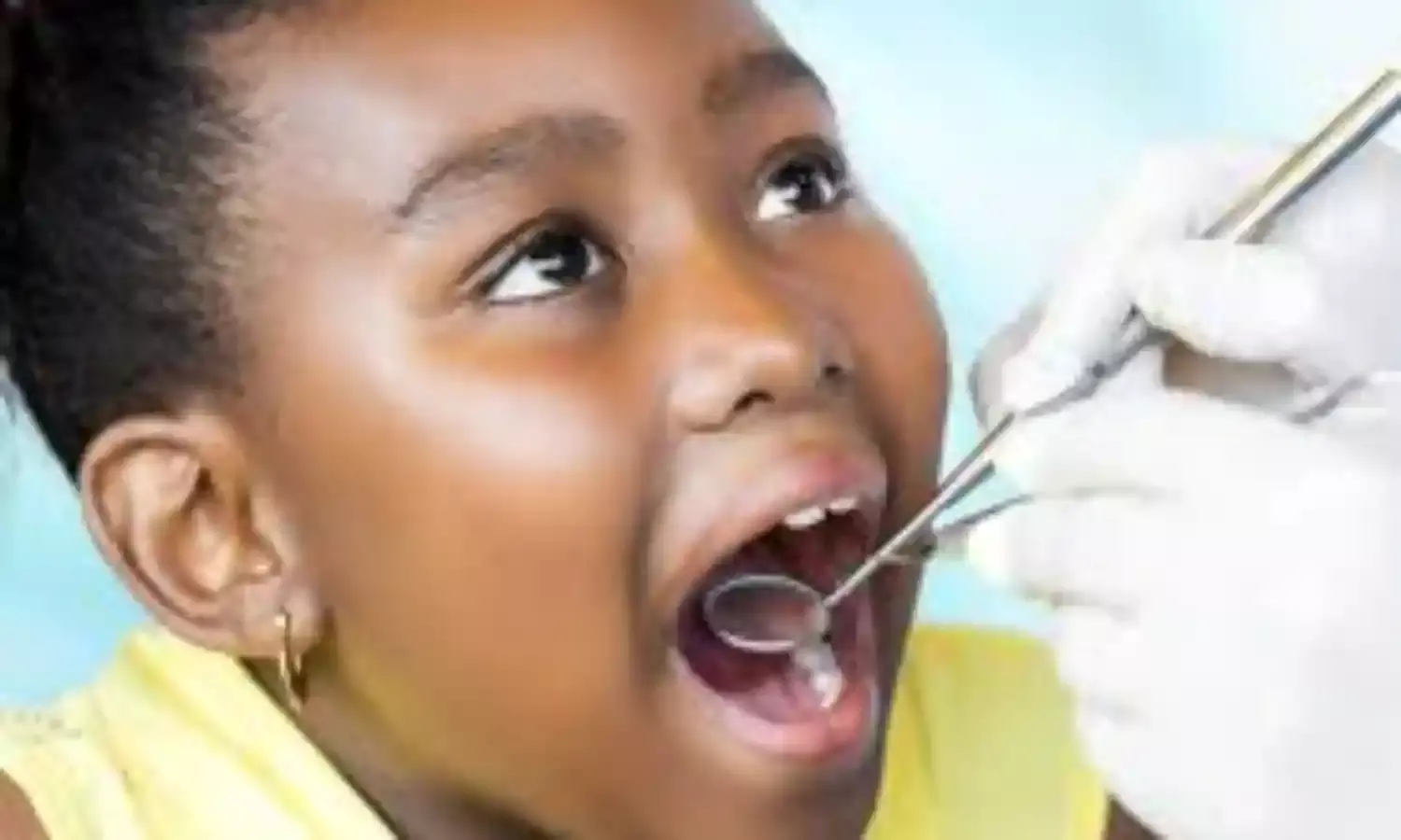 Thumb Sucking Causes Dental Malformation, says Dentist