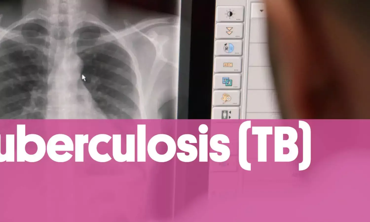 Tuberculosis: CSO Seeks More Sensitisation, Media Partnership to Tackle Spread