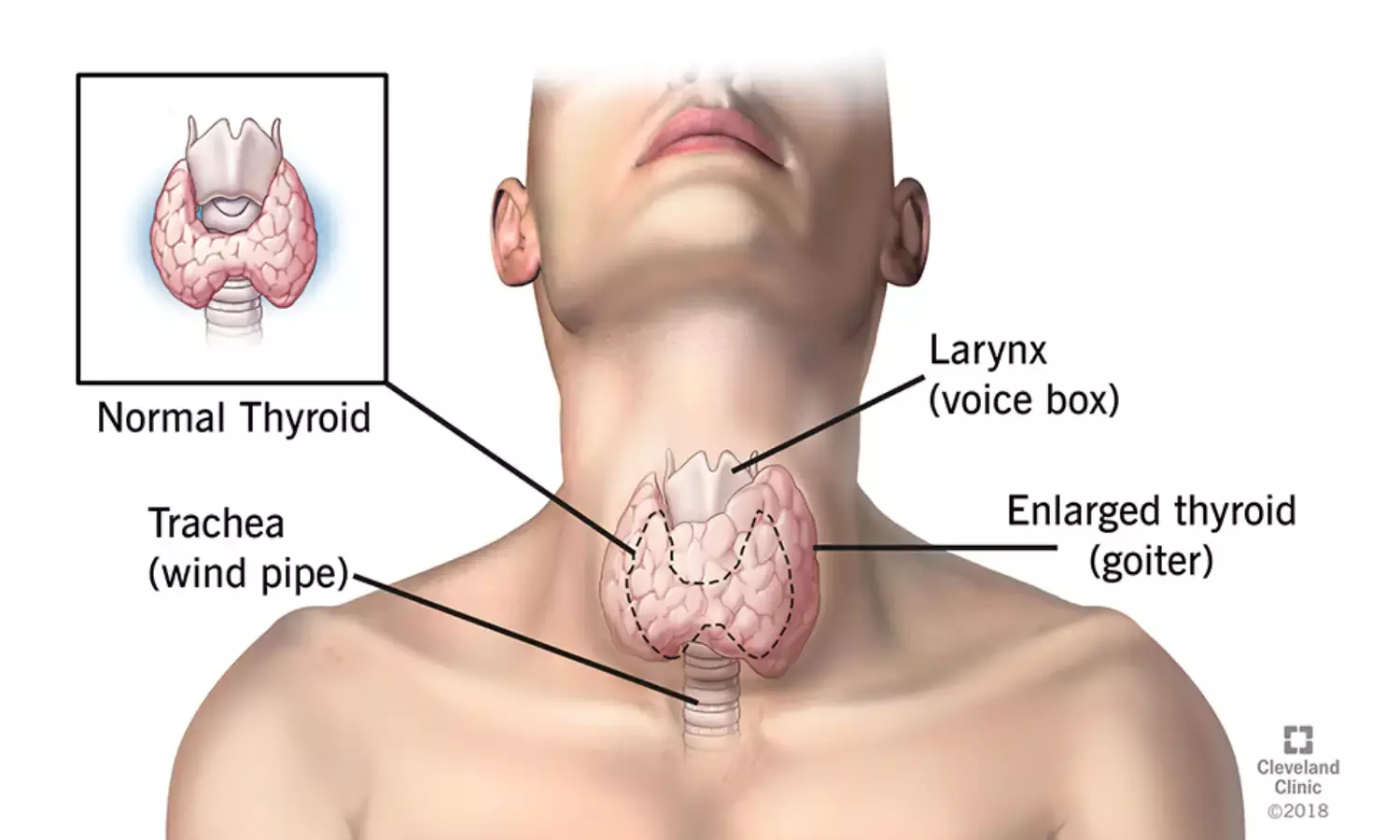NGO calls for awareness on prevention, treatment, management of thyroid disease