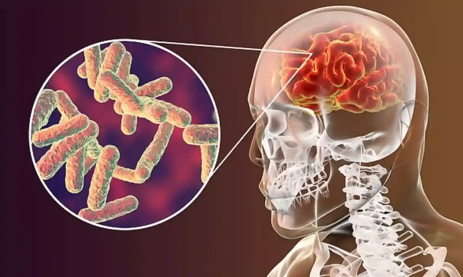 Expert wants public to watch out for symptoms of meningitis