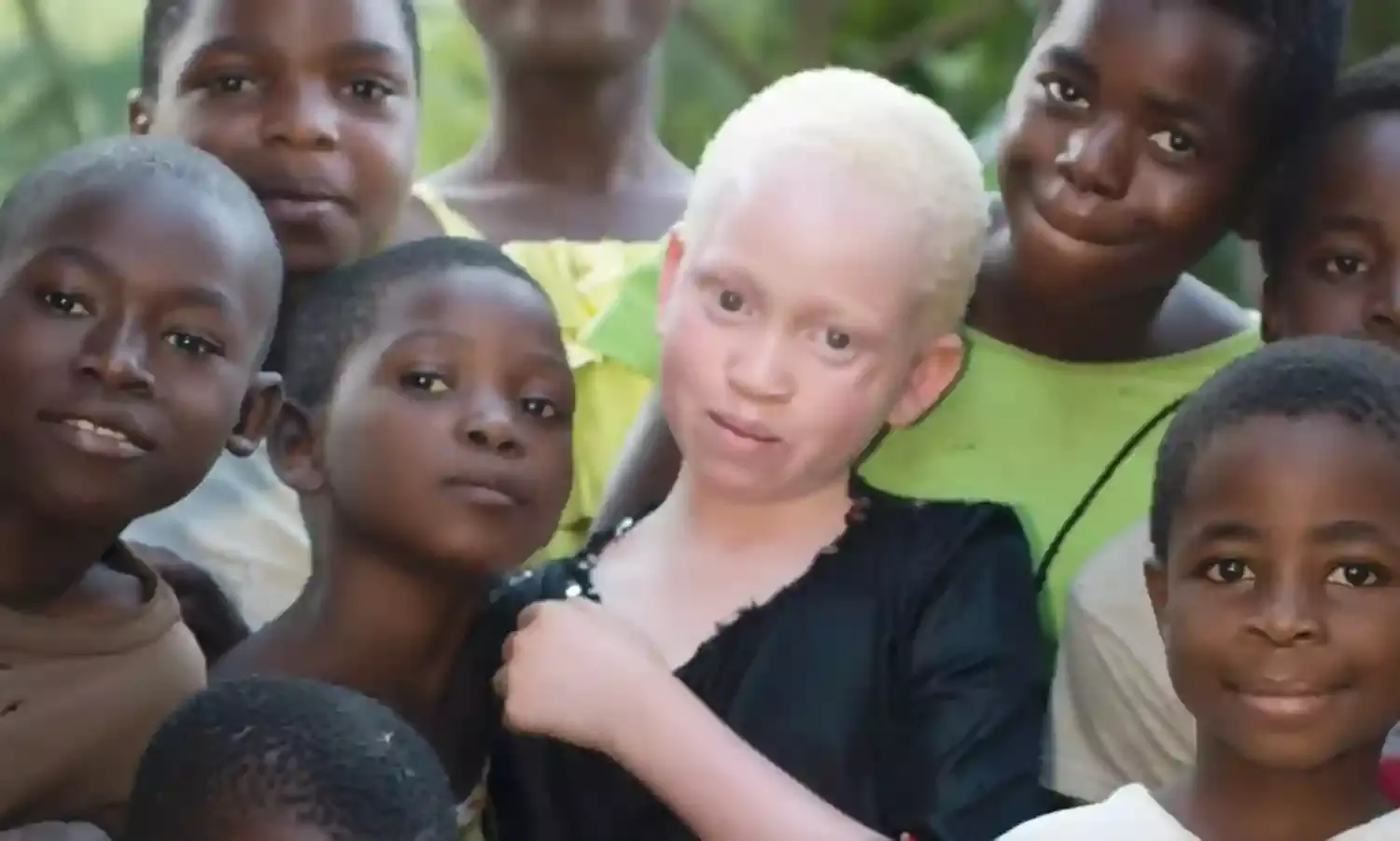 Skin cancer: Be `sun smart’, Foundation advises albinos