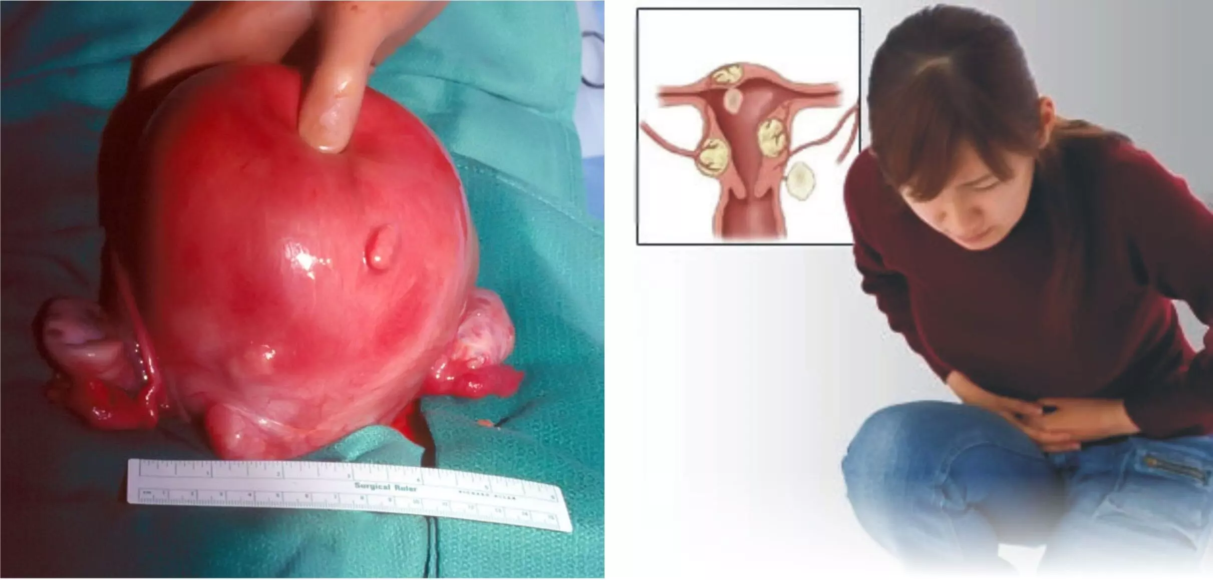 5 SIGNS OF FIBROID 5 SIGNS OF FIBROID