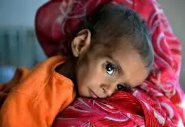 Children suffer malnutrition in Afghanistan