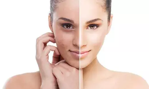 Stop bleaching or risk Coronavirus disease – Medical expert