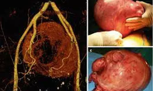 Preventing fibroids formation via healthy diet, early child-bearing