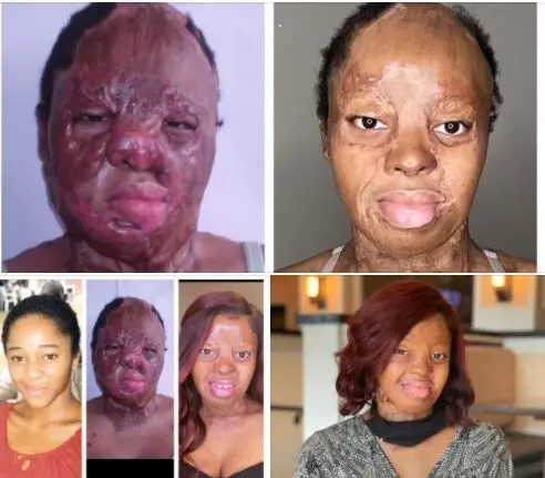 Kechi Okwuchi grateful for recovery journey of facial scars