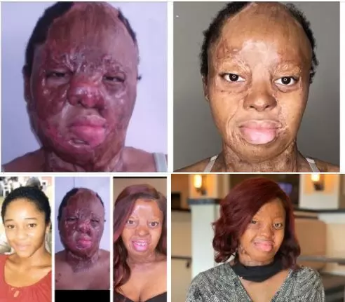 Kechi Okwuchi grateful for recovery journey of facial scars Kechi Okwuchi grateful for recovery journey of facial scars