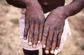 Monkey pox: NCDC registers 59 suspected cases,15 confirmed